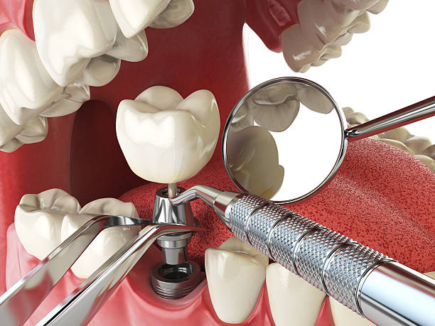 Best Emergency Tooth Extraction in Cottleville, MO